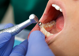 歯科衛生士での専門的な口腔内清掃（PMTC）。行き届かないところの歯の汚れまで落とし、口腔トラブルを予防します。
