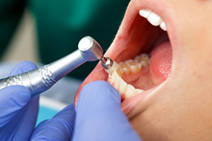 PMTC（プロフェッショナルクリーニング）という専門的な口腔内清掃。普段では取れない歯石などの歯の汚れを落とし、虫歯、歯周病予防に徹します。